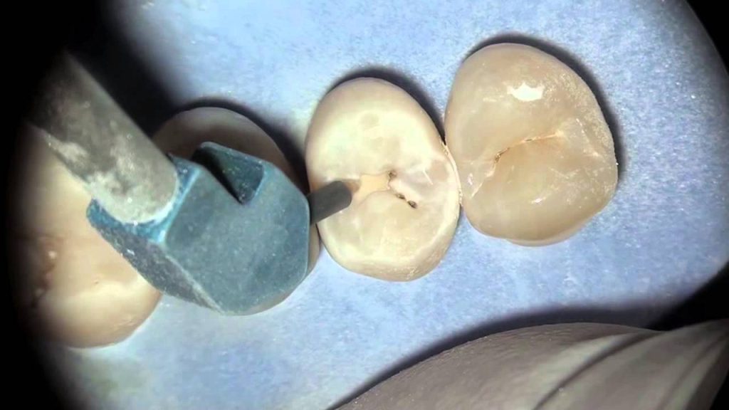 dental sealant 01