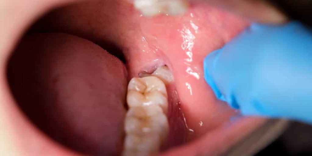 wisdom tooth removal
