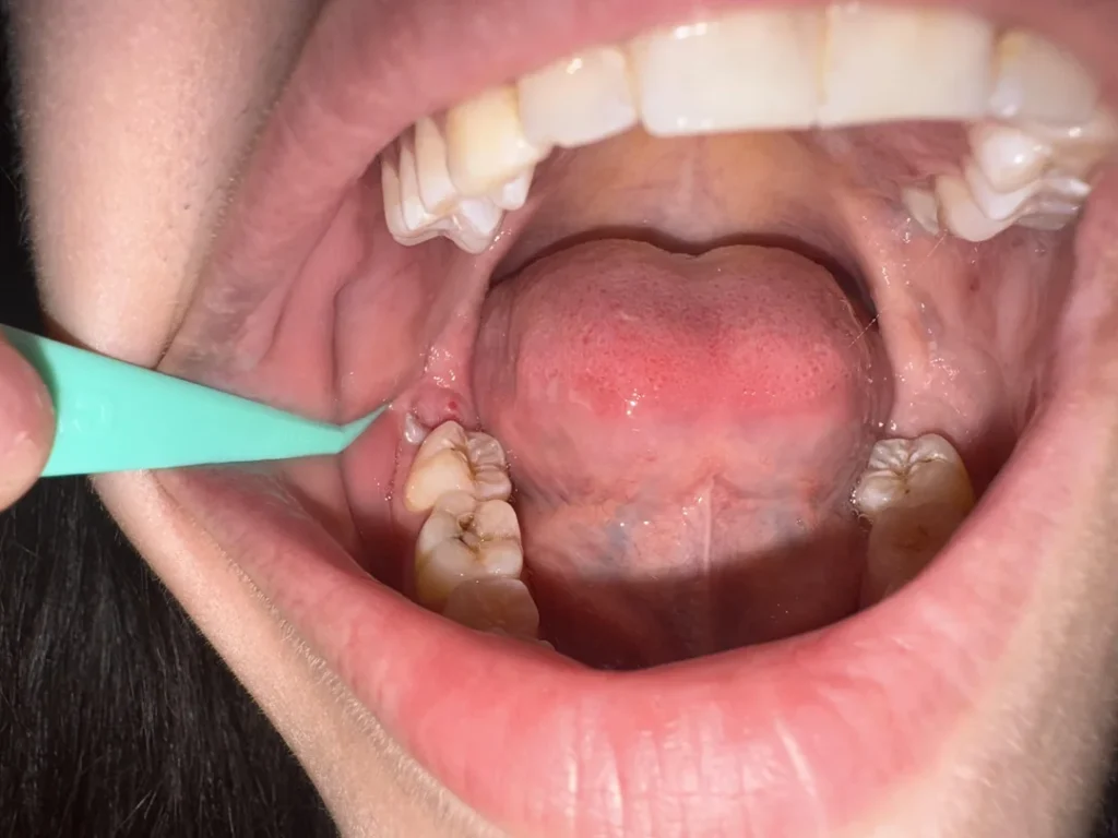 wisdim tooth pain