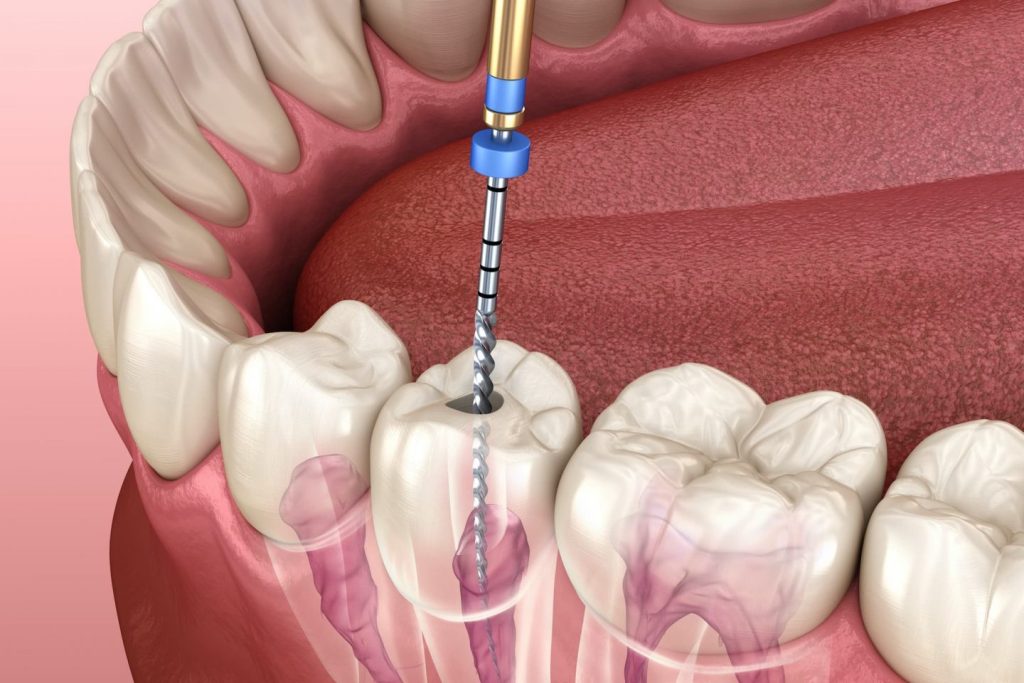 Root Canal Treatment 01