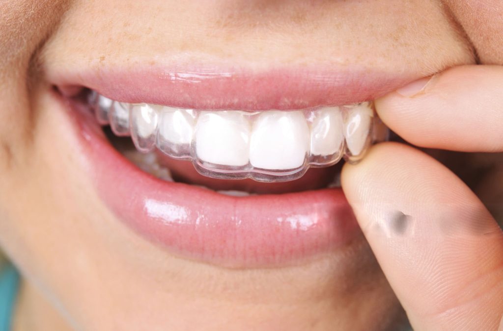 invisalign