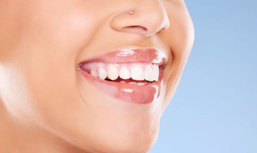 Professional teeth whitening