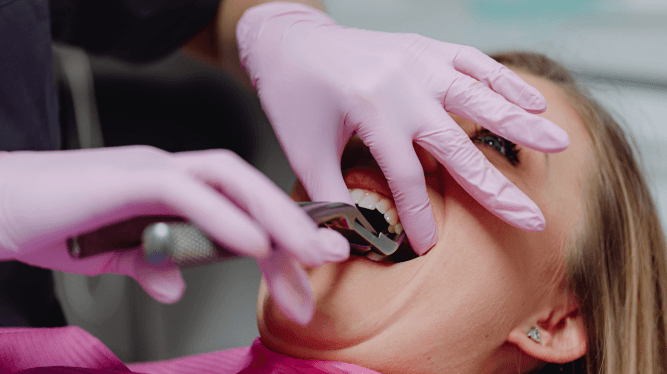 Wisdom tooth extraction