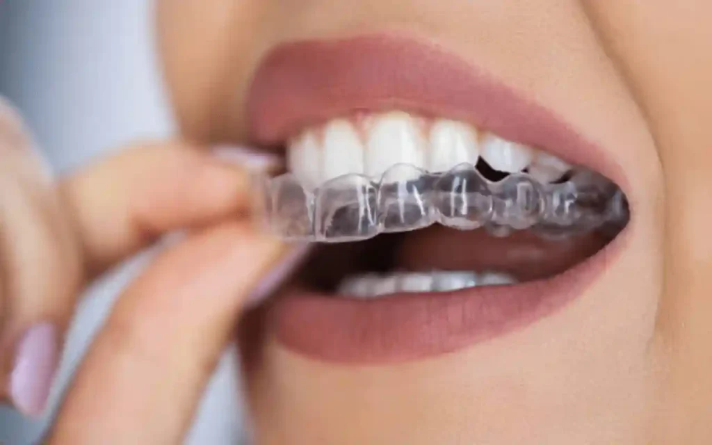 Invisalign