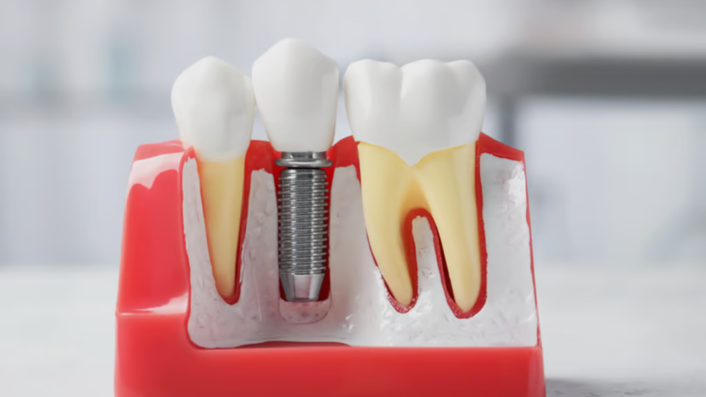 dental implants