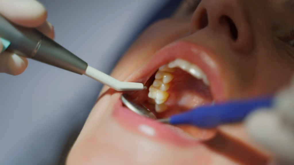 dental filling