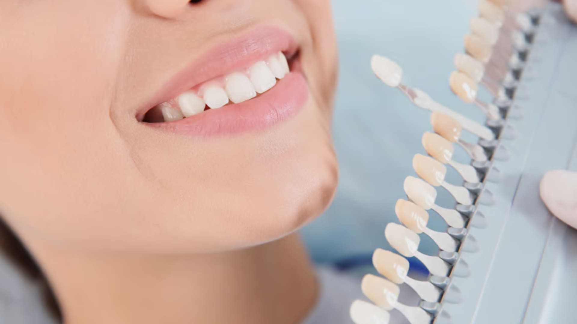Dental Veeners