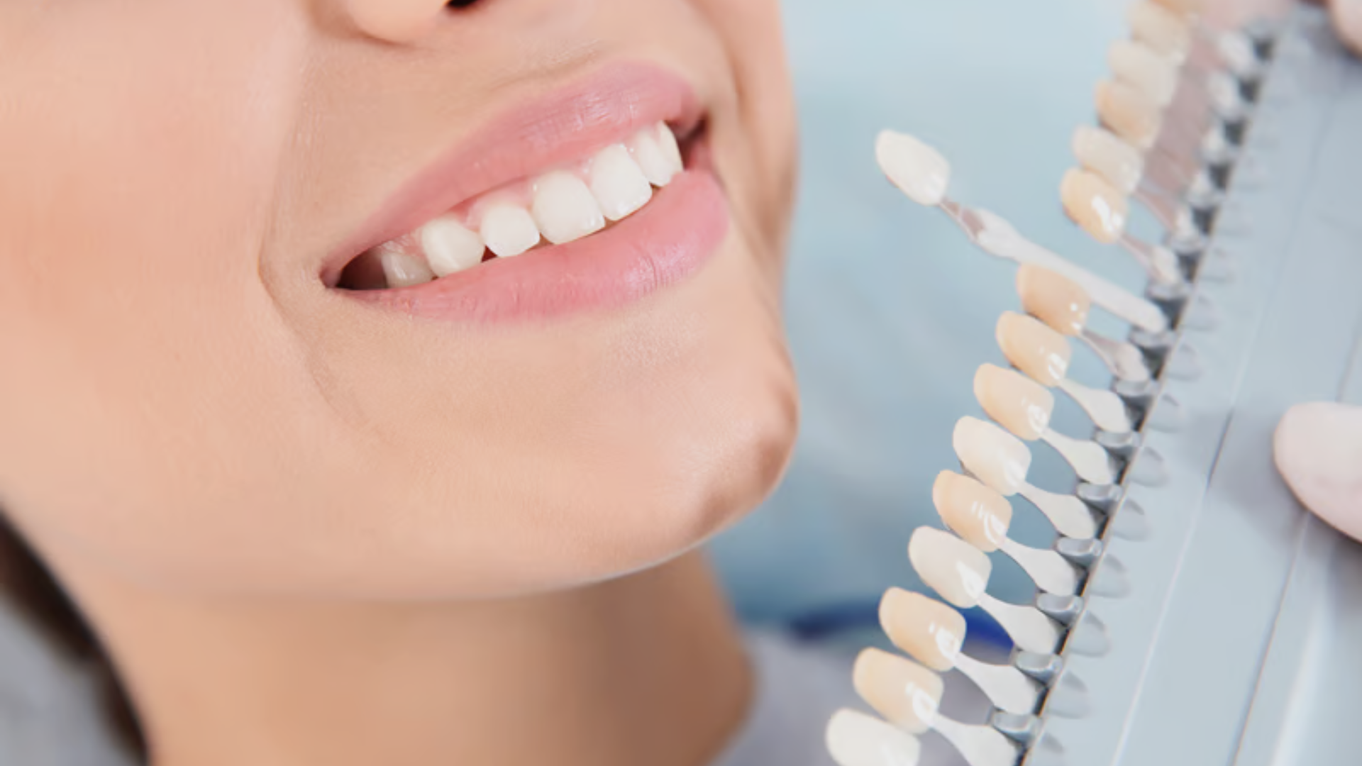veneers dental