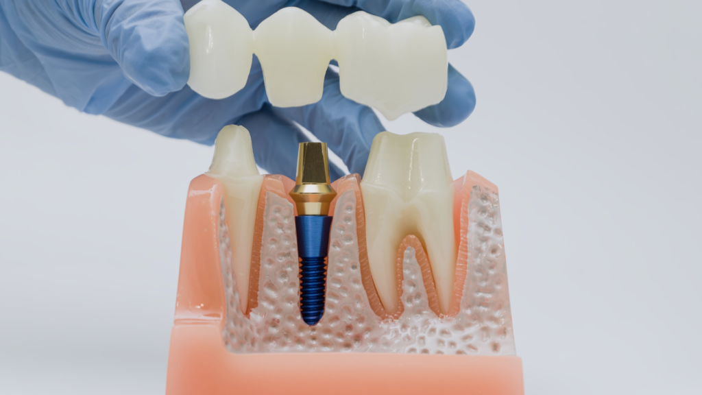 dental bridge