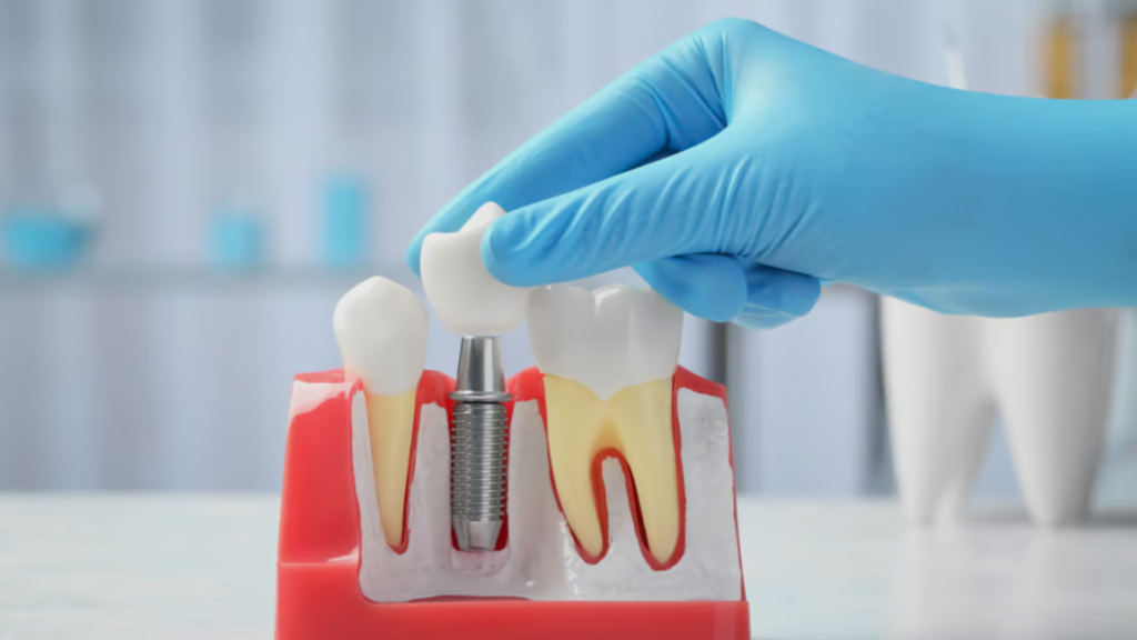 bridge dental