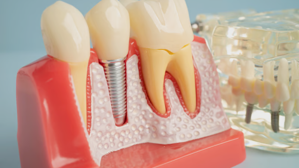 dental bridges brampton
