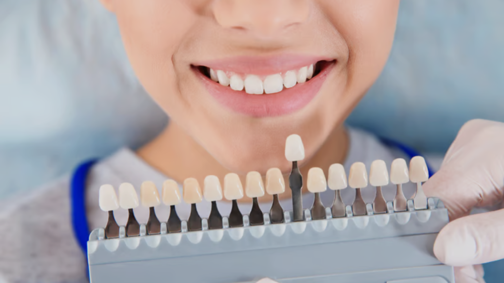 dental veneers