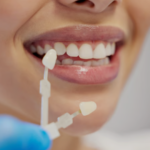 What is dental veneers before and after?