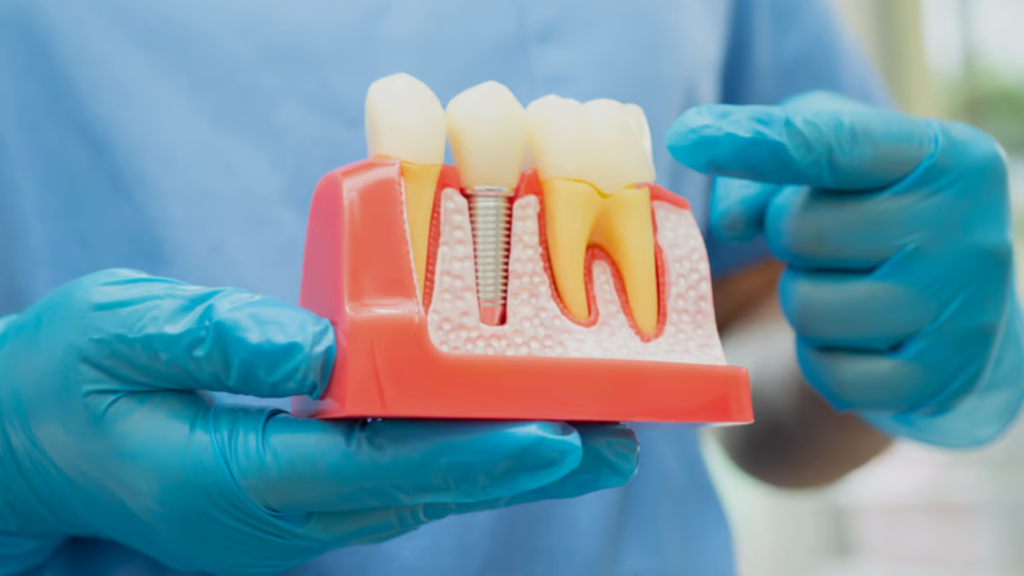 dental implants