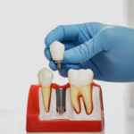 Can you fix a broken dental bridges?