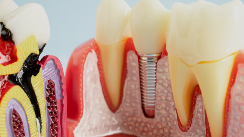 dental implants