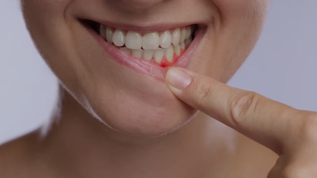 Bleeding gums