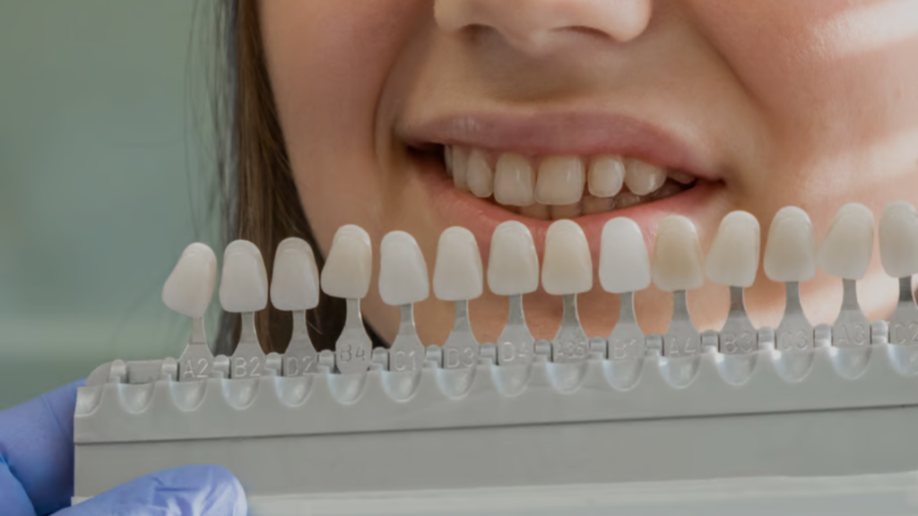 Dental veneers