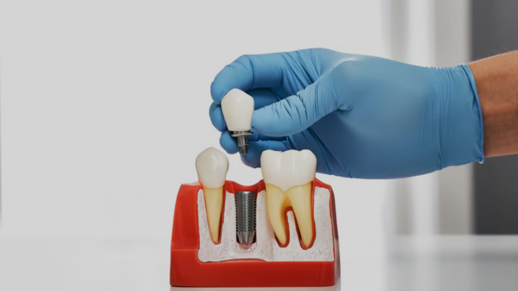 dental implant treatment in delta park dental