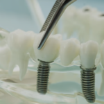Dental Bridge vs Implant: Which Is Best for a Missing Tooth?