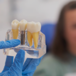 How Much Do Dental Implants Cost in Brampton? (2026)